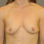 Breast Augmentation Before & After Patient #12112