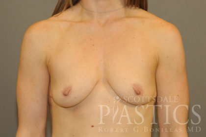 Breast Augmentation Before & After Patient #12112