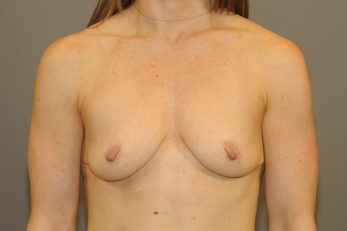 Breast Augmentation Before & After Patient #12112