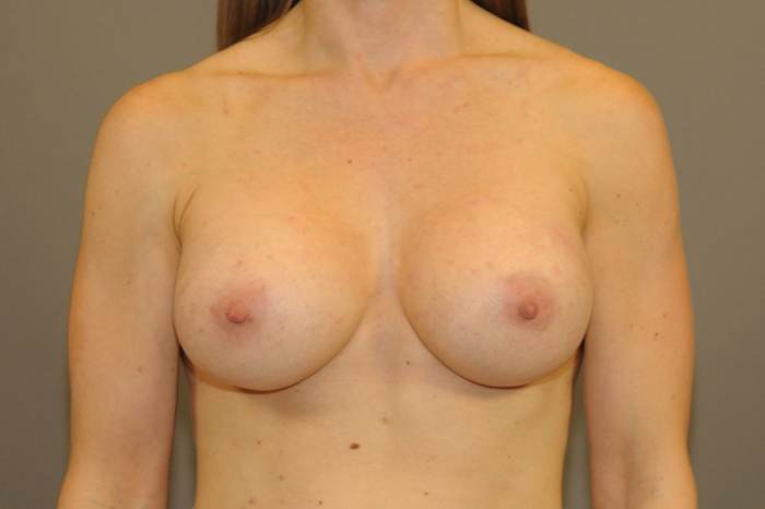 Breast Augmentation Before & After Patient #12112