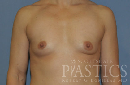 Breast Augmentation Before & After Patient #12119