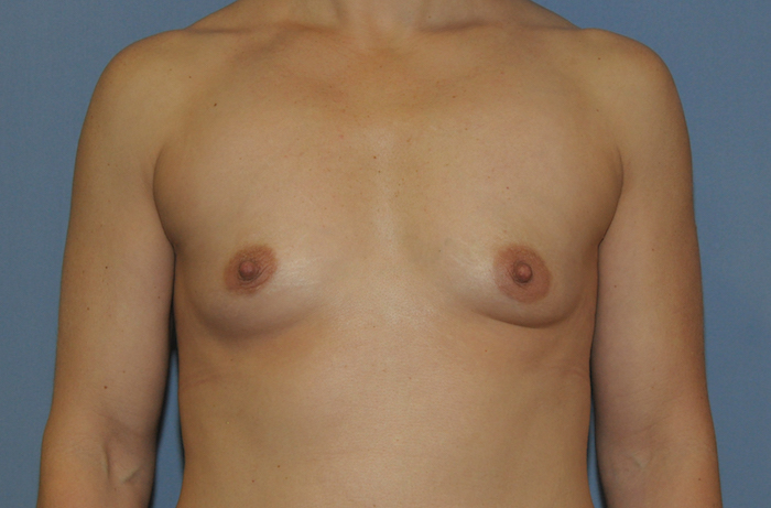 Breast Augmentation Before & After Patient #12119