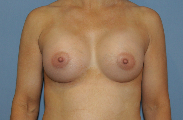 Breast Augmentation Before & After Patient #12119