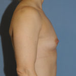Breast Augmentation Before & After Patient #12119