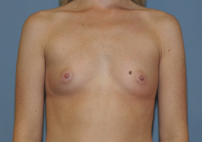 Breast Augmentation Before & After Patient #12126