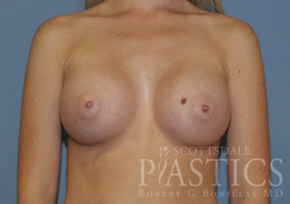 Breast Augmentation Before & After Patient #12126