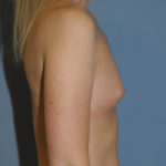 Breast Augmentation Before & After Patient #12126