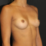 Breast Augmentation Before & After Patient #12133