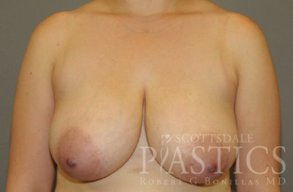 Breast Reduction Before & After Patient #12144