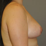 Breast Reduction Before & After Patient #12144
