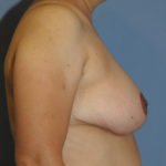 Breast Reduction Before & After Patient #12151