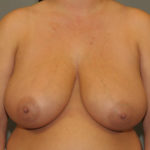 Breast Reduction Before & After Patient #12158