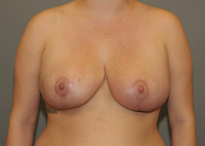 Breast Reduction Before & After Patient #12158