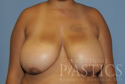 Breast Reduction Before & After Patient #12165