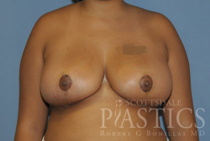 Breast Reduction Before & After Patient #12165
