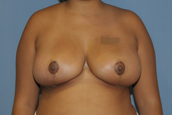 Breast Reduction Before & After Patient #12165