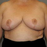 Breast Reduction Before & After Patient #12172
