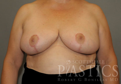 Breast Reduction Before & After Patient #12172