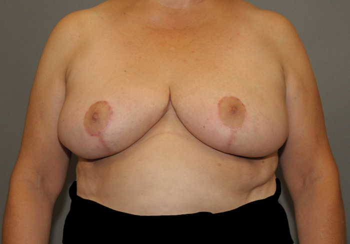 Breast Reduction Before & After Patient #12172