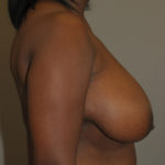 Breast Reduction Before & After Patient #12179