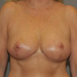 Breast Reduction Before & After Patient #12186