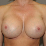 Breast Implant Revision Before & After Patient #12193