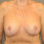 Breast Implant Revision Before & After Patient #12213