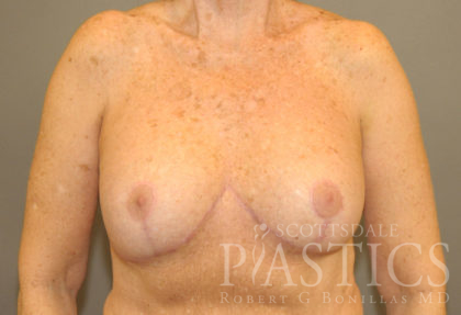 Breast Implant Revision Before & After Patient #12213