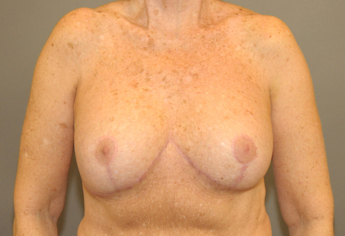 Breast Implant Revision Before & After Patient #12213