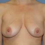 Breast Implant Revision Before & After Patient #12220
