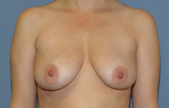Breast Implant Revision Before & After Patient #12220