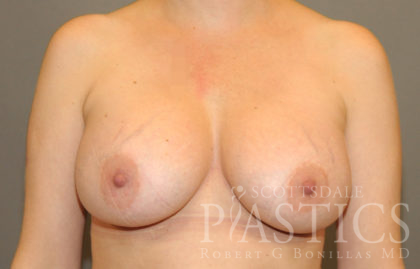 Breast Implant Revision Before & After Patient #12220