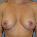 Breast Implant Revision Before & After Patient #12227