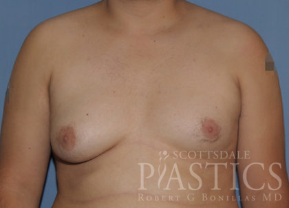Gynecomastia Before & After Patient #12234