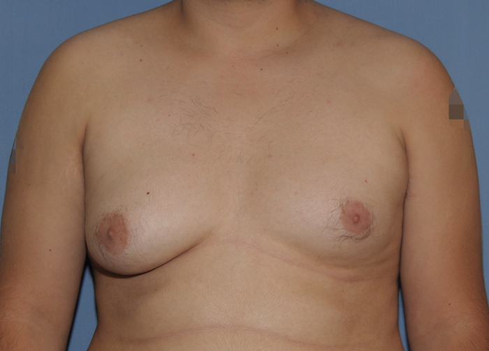 Gynecomastia Before & After Patient #12234
