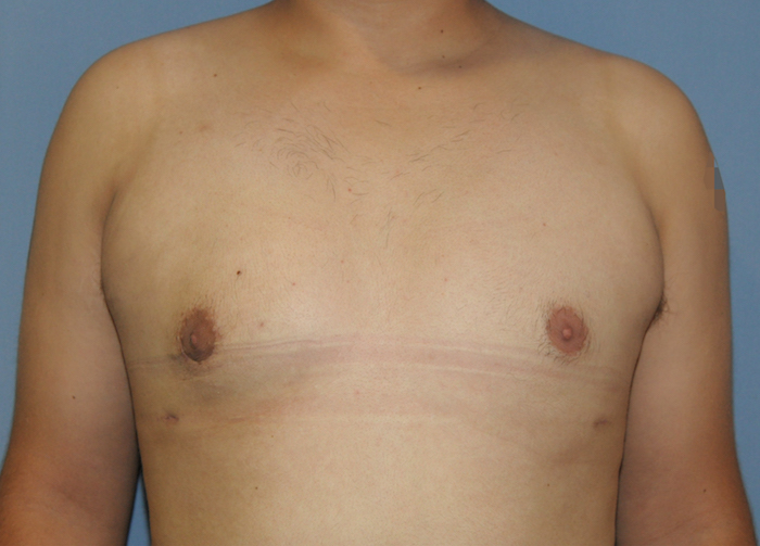 Gynecomastia Before & After Patient #12234
