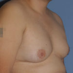 Gynecomastia Before & After Patient #12234