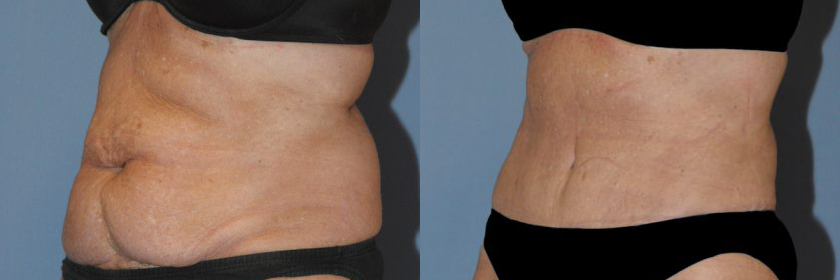 breast augmentation and tummy tuck recovery