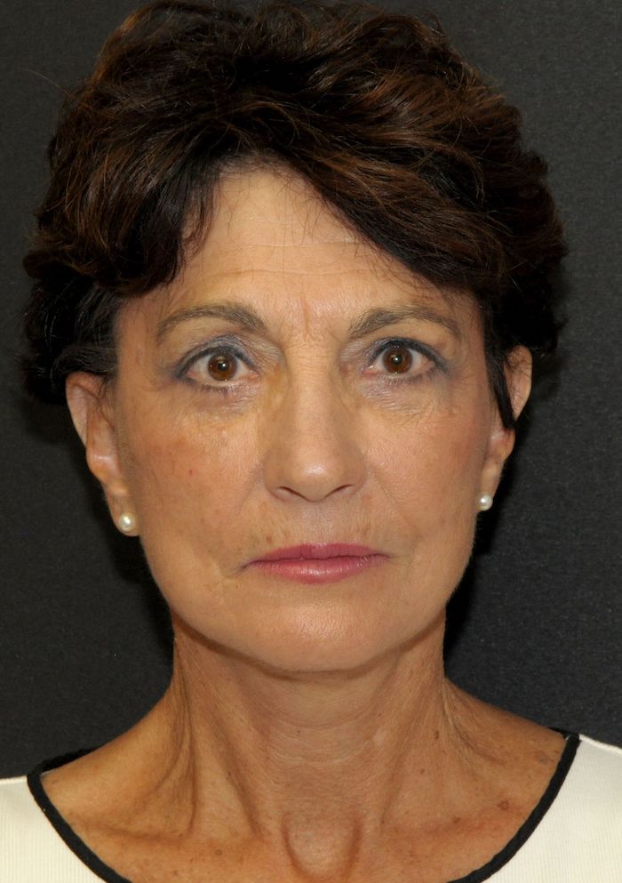 Before and After Photos Mesa Plastic Surgery Gallery Tempe Dr