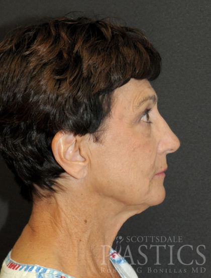 Facelift Before & After Patient #12280