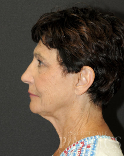 Facelift Before & After Patient #12280