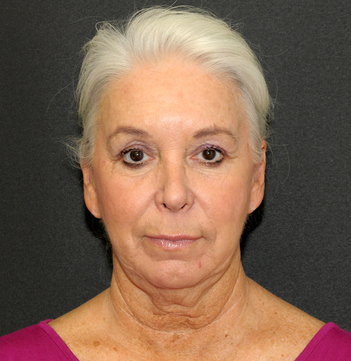 Facelift Before & After Patient #12291