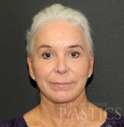 Facelift Before & After Patient #12291