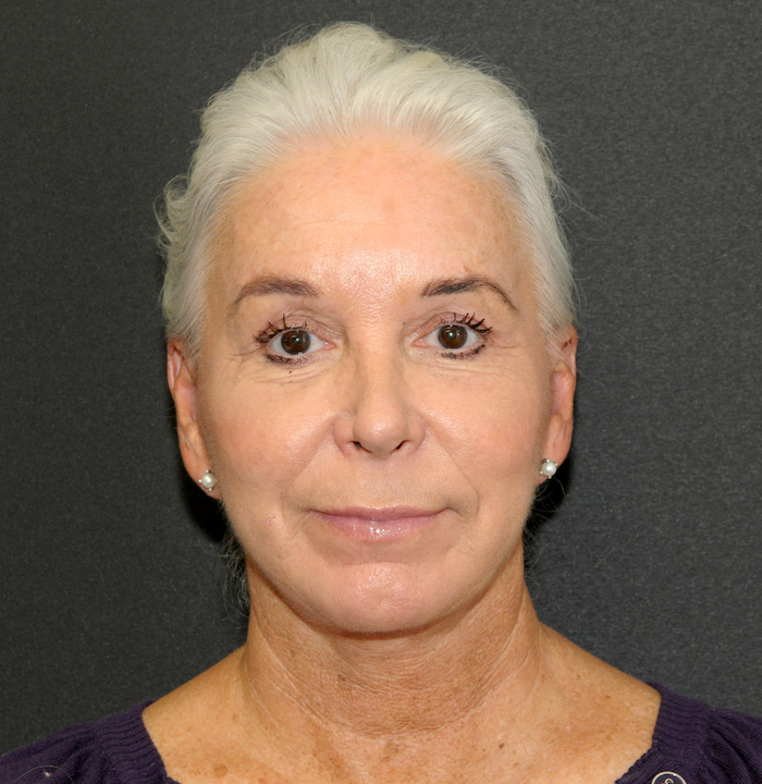 Before and After Photos Mesa Plastic Surgery Gallery Tempe Dr