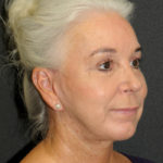 Facelift Before & After Patient #12291