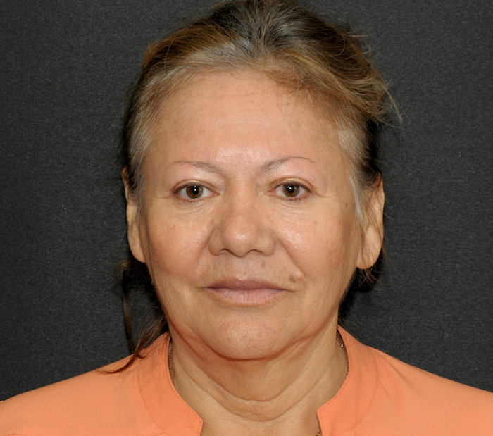 Before and After Photos Mesa Plastic Surgery Gallery Tempe Dr