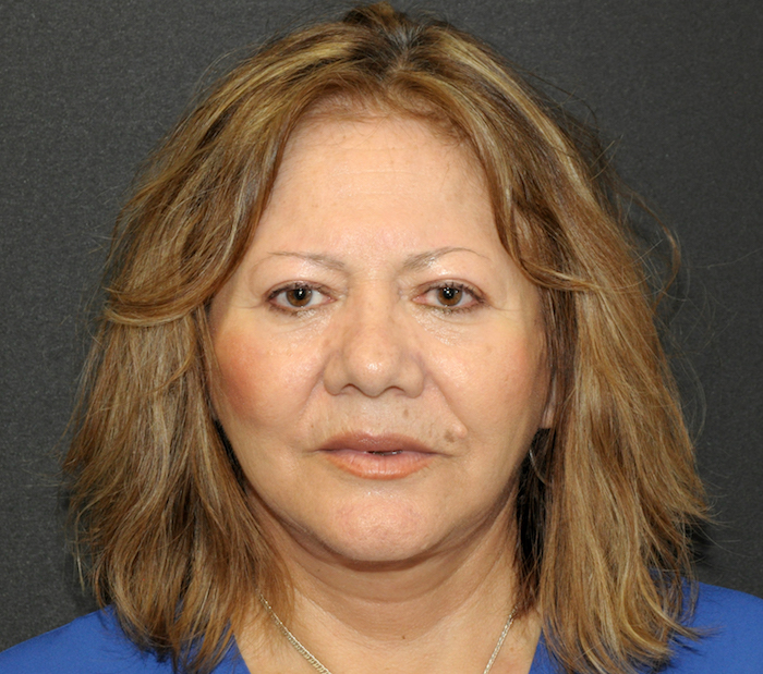 Before and After Photos Mesa Plastic Surgery Gallery Tempe Dr