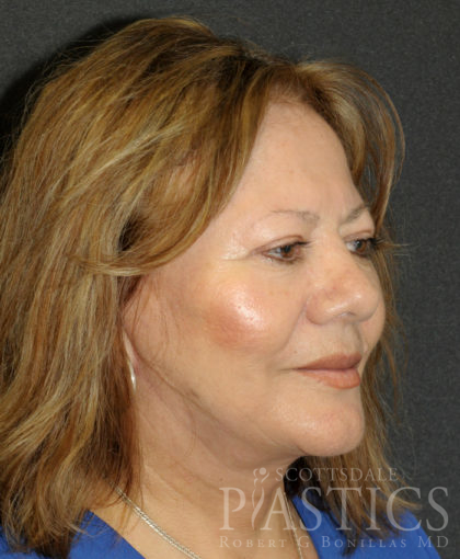 Facelift Before & After Patient #12302