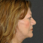 Facelift Before & After Patient #12302