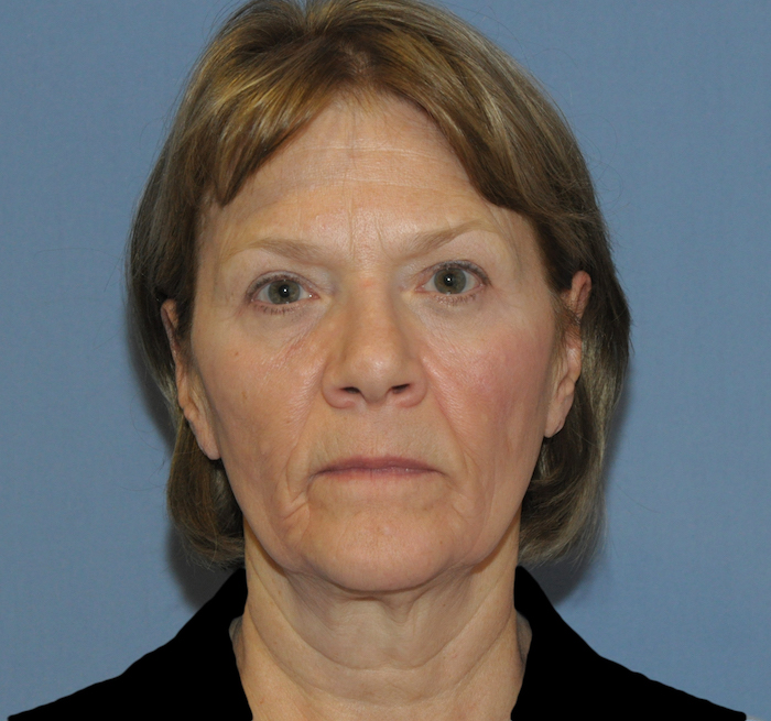 Facelift Before & After Patient #12313